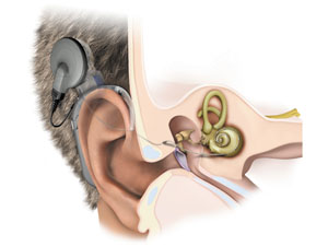 Können Hörgerät und Cochlea-Implantat vor geistigem Abbau im Älter schützen?